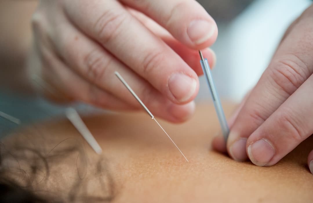 The Science Behind Acupuncture: How It Works